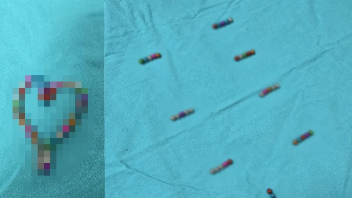 Bursa’da akılalmaz olay: 5 yaşındaki çocuğun bağırsağından çıkanlar şoke etti! Tam 38 adet!